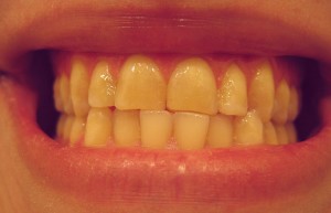 Tooth wear caused by teeth grinding